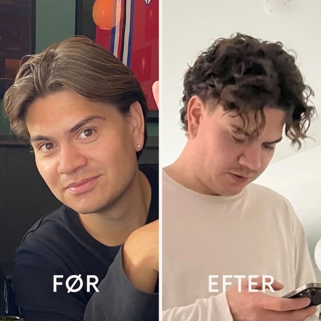 Det nuværende billede har ingen alt-tekst. Filnavnet er: before-after-minimal-skincare-instagram-post-3-1.jpg